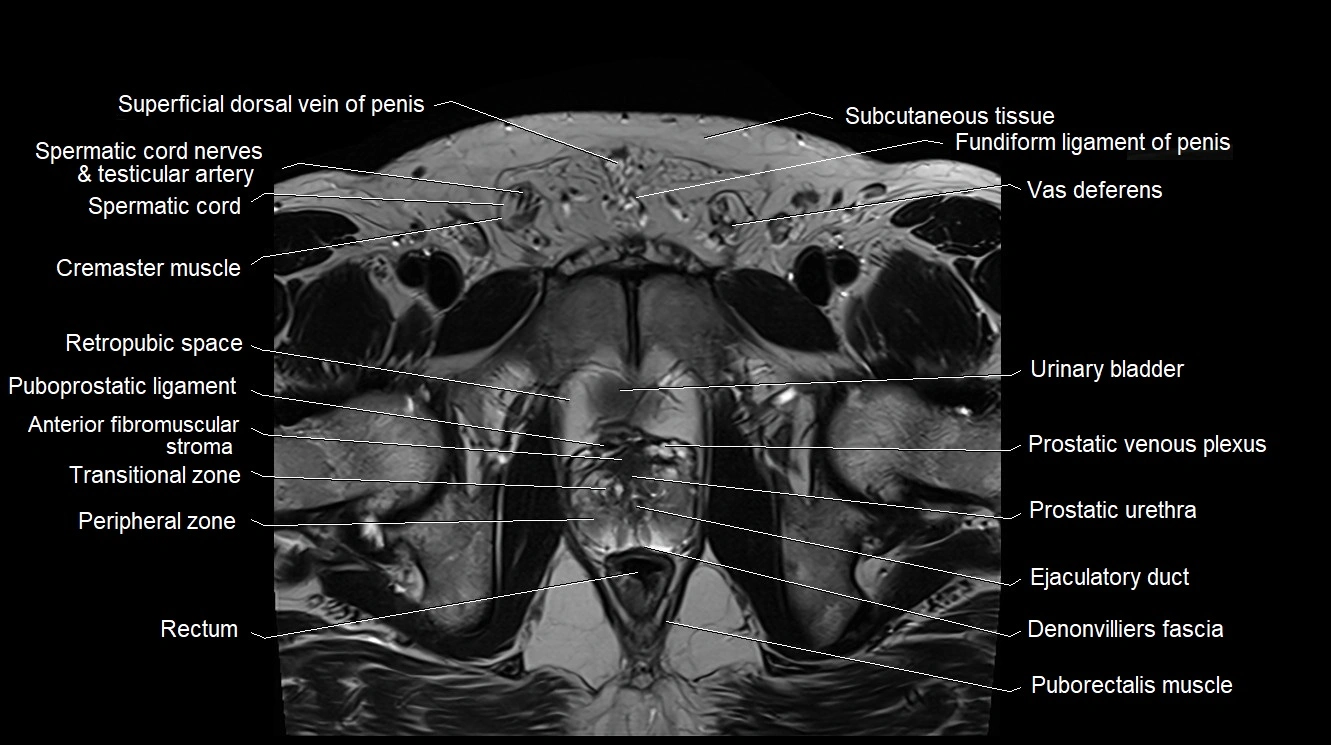 MRI 3T scrotum and penis axial cross sectional anatomy image 9.webp